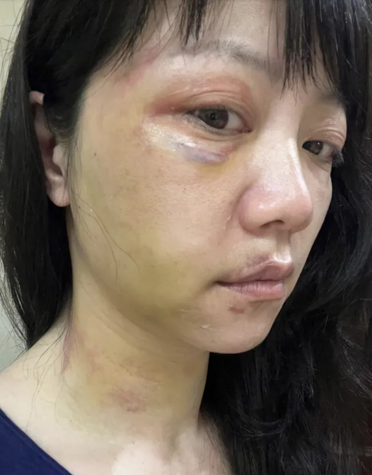 高嘉瑜的臉被林秉樞打得瘀青腫脹。高嘉瑜辦公室提供