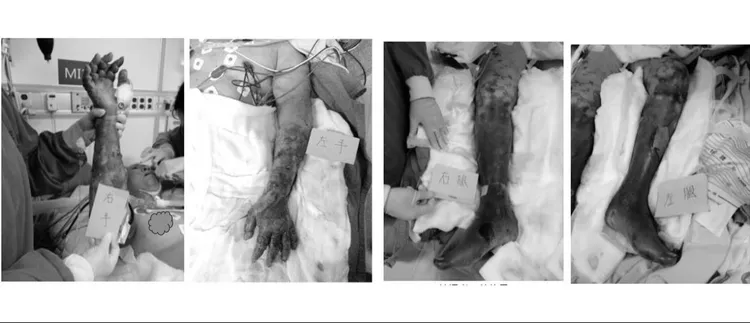 漢生病引發罕見「Lucio氏現象」，其特點是四肢皮膚出現紫紺狀斑塊，造成嚴重壞死。三總提供