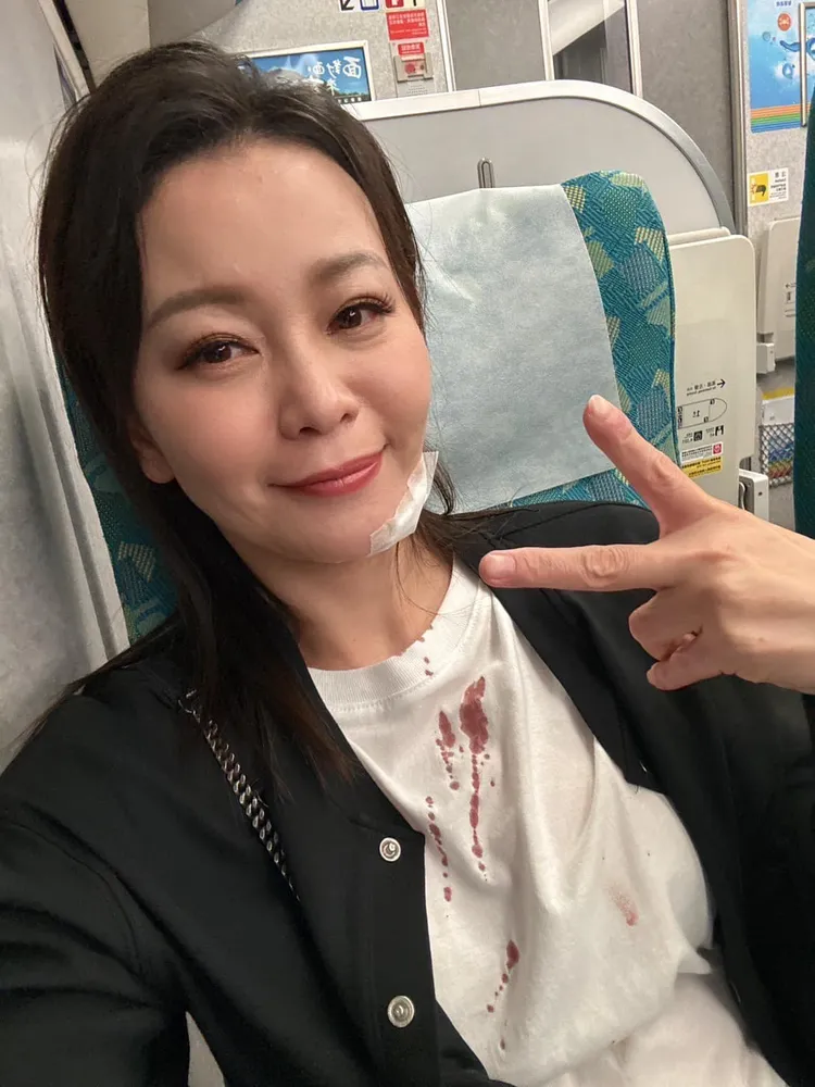 謝宜君日前摔傷破相。翻攝謝宜君臉書