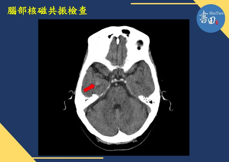 這位先生核磁共振檢查，證實右側大腦顳葉有纖維化病變。書田診所提供