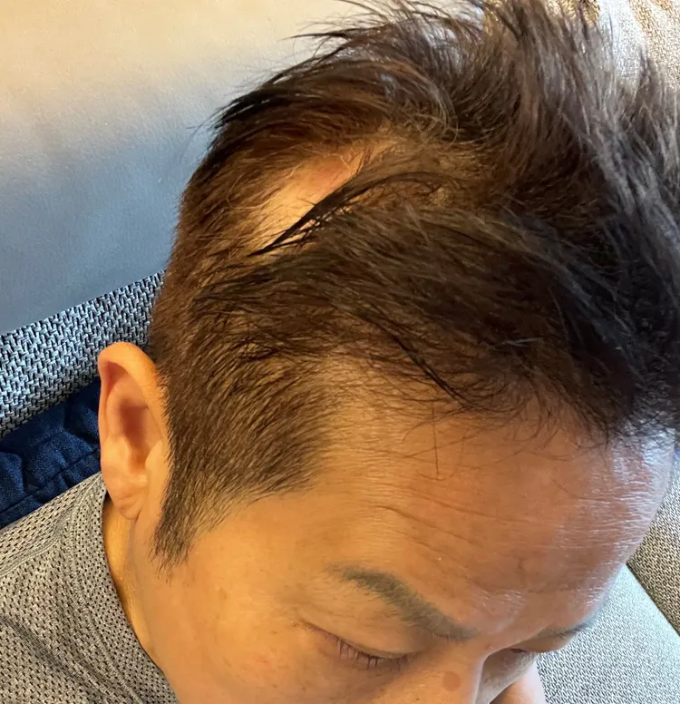 徐乃麟也曾頭皮禿一塊。資料照片