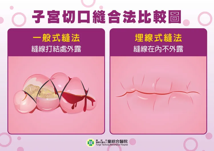 子宮切口縫合法比較圖。院方提供