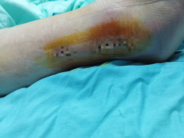 女大生摔倒骨折，送醫開刀。讀者提供