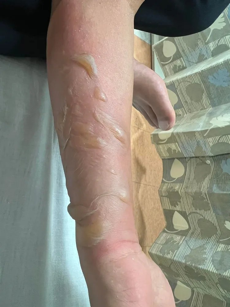 李康生手臂燙傷情況嚴重。翻攝自李康生IG