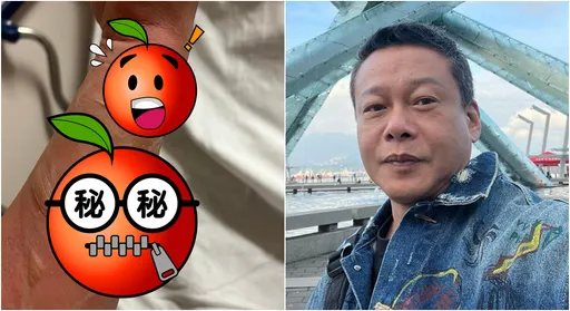 金马影帝被烫伤！起水泡惊悚照曝　急诊等8小时「严重的早挂了」