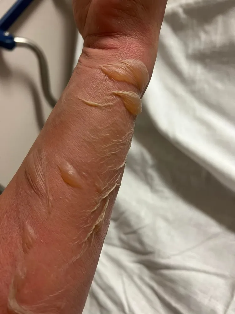 李康生手臂燙傷情況嚴重。翻攝自李康生IG