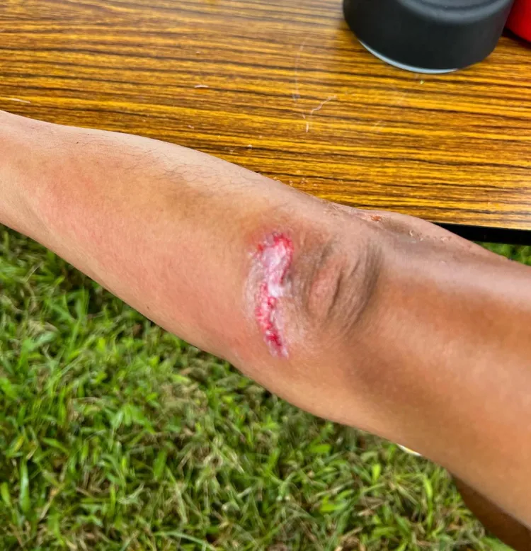 陳彥博重摔後，吸氣腰與側腹非常痛。翻攝自陳彥博臉書