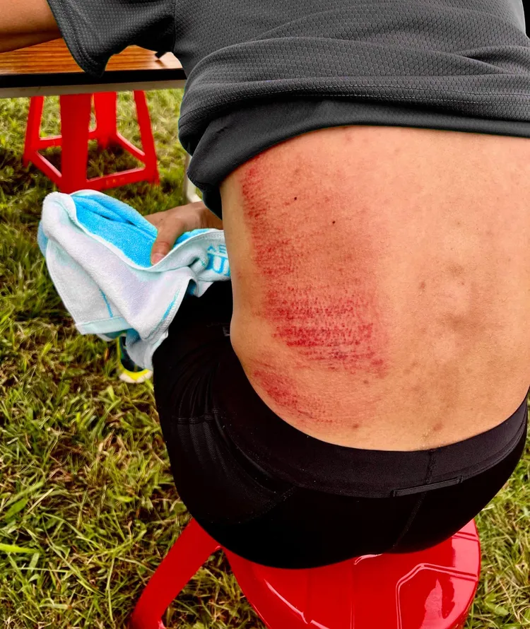 陳彥博背部受傷。翻攝自陳彥博臉書