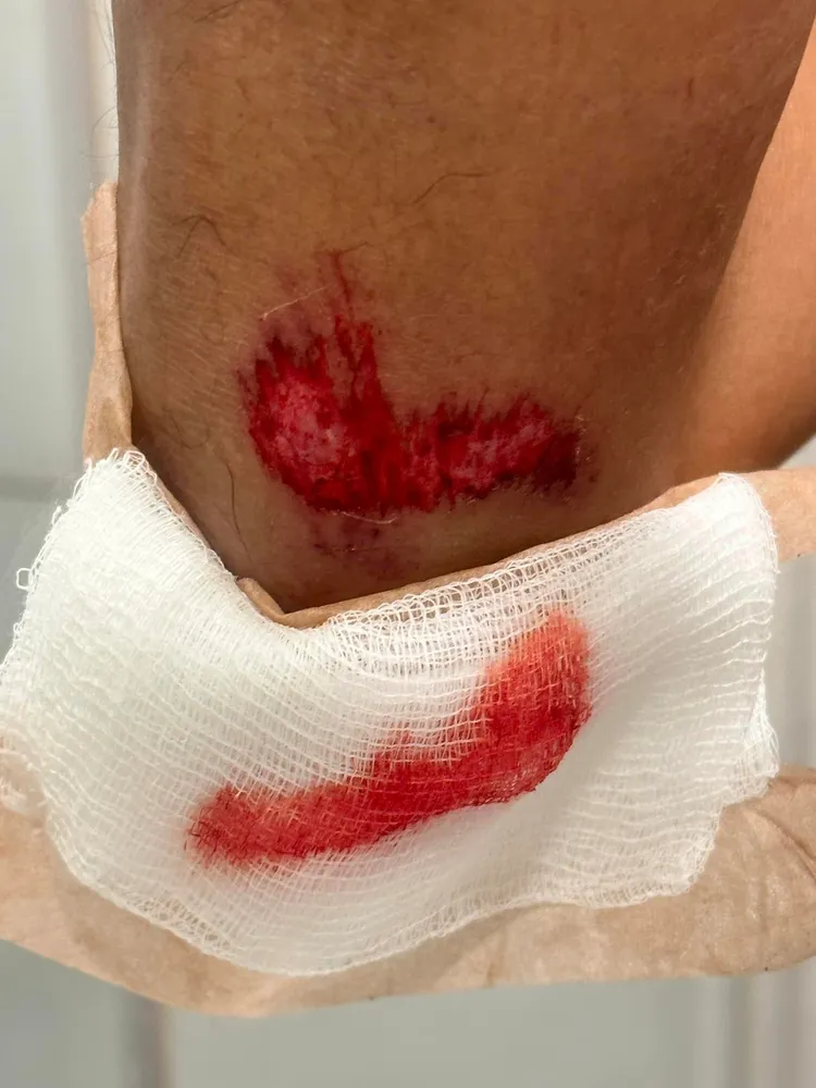 腳也受傷流血。翻攝自陳彥博臉書