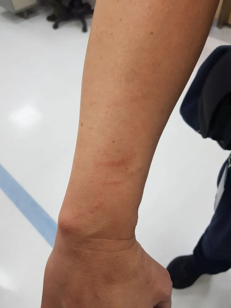 警方手臂遭拳頭攻擊紅腫。翻攝畫面