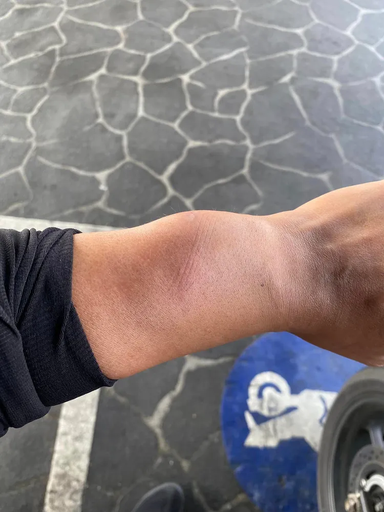 被害人手臂被打傷。民眾提供