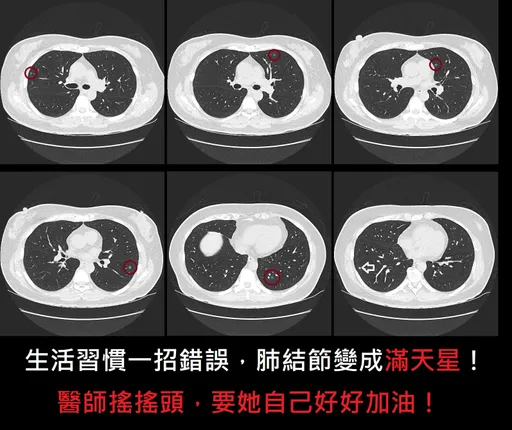 1要命錯誤習慣!肺結節1顆變「滿天星」 醫師搖頭:好好加油