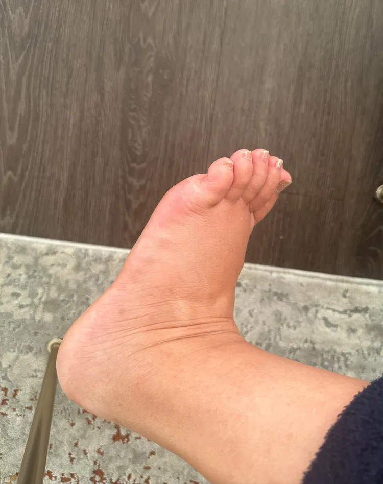 祈錦鈅懷孕後期水腫嚴重。翻攝自祈錦鈅臉書