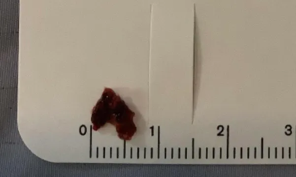 病患血栓塊塞住腦血管，以「動脈取栓術」取出。院方提供