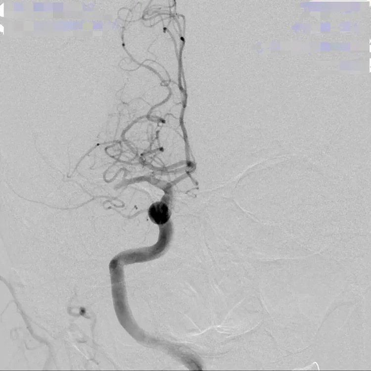 病患的血管攝影可看出，右半邊後面的血管都不見了，即血栓塞住，血流過不去。院方提供
