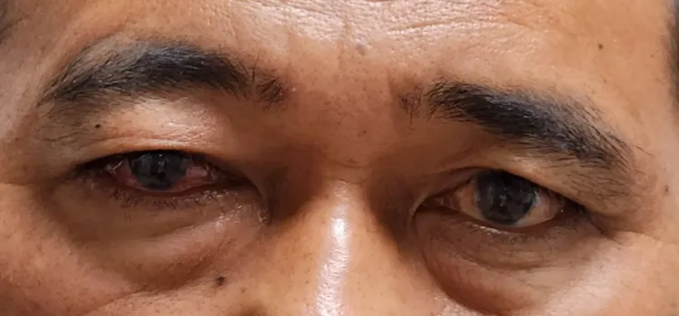 患者左右眼明顯有高低差。豐原醫院提供