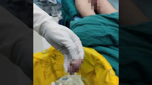 女友分手砲「口愛斷陰莖」　奇蹟接回後兩人竟然復合了