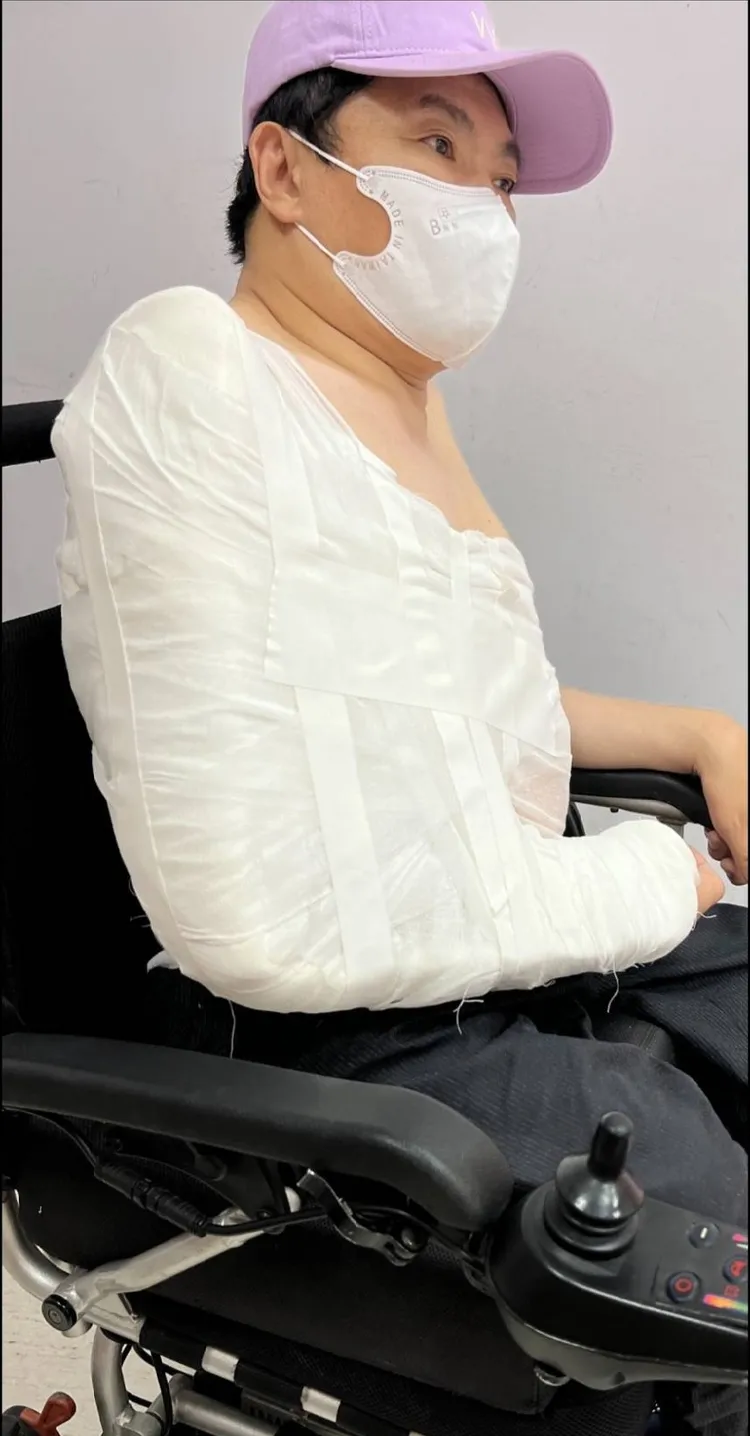 蔡義德不良於行，又摔傷右手。蔡義德提供