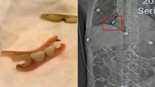 住院治胃病「假牙掉進肺裡」 患者反覆感染至死牙齒還在裡面