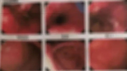 除草劑當飲料喝「不敢告訴爸媽」　14歲少年從嘴到胃全腐蝕