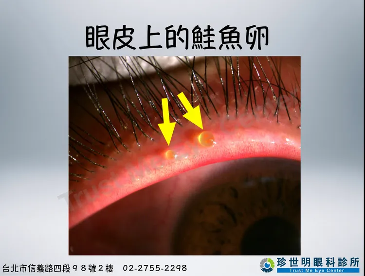 眼皮竟然冒出「2顆鮭魚卵」。翻攝臉書「王孟祺醫師-眼科最前線」