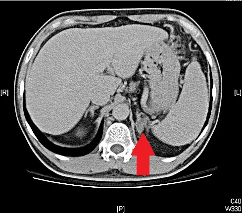 經電腦斷層發現，病患左側腎上腺出現腫瘤 (紅色箭頭處)。院方提供