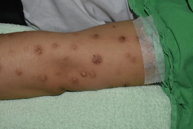 結節性癢疹病友容易因為搔癢影響睡眠，更進一步引起身心疾病。蔡呈芳醫師提供