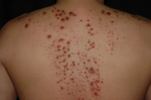 愈抓愈癢!小心摳出棘手結節性癢疹 洗腎、糖友風險高