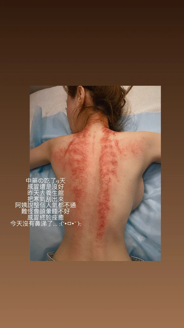 張語昕躺在床上，背上出現兩道明顯血痕。翻攝自張語昕IG