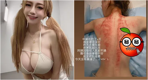 I罩杯女模「滿滿血痕」慘照曝光　乳球掉出來！網友驚呆