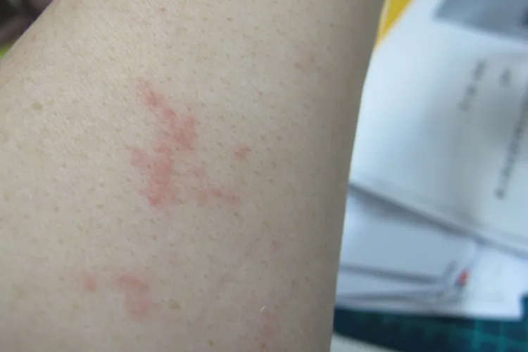 臭蟲叮咬後的傷痕。取自環境部網站
