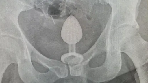 肛塞「助性」糗被吸入體內 她就醫求援:取出時是難以忍受的痛苦