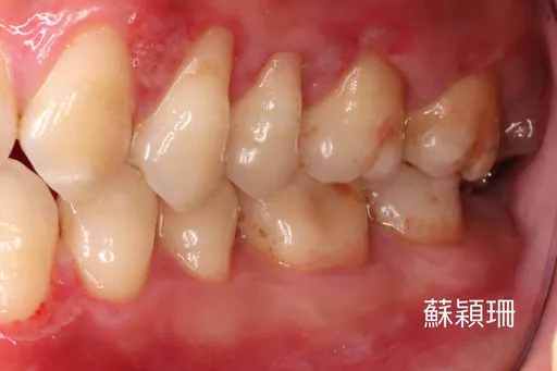 30歲以上易牙齦退縮!她2個壞習慣 害牙齒變長易流血