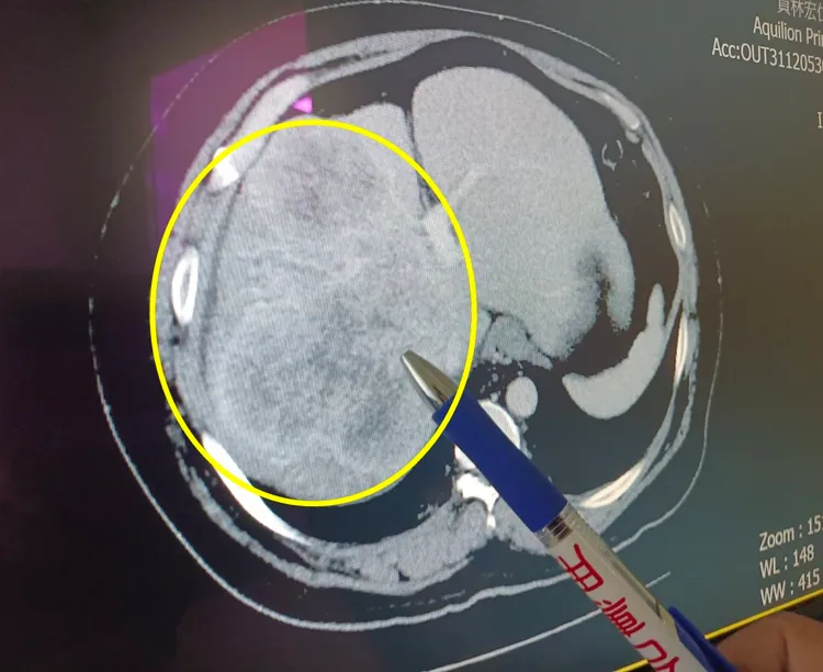進行手術前影像檢查(腫瘤部位為黃色圓圈處)。童醫院提供