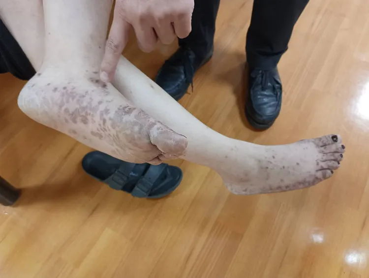 蕭小姐的雙腳也滿是紅疹。部立彰化醫院提供