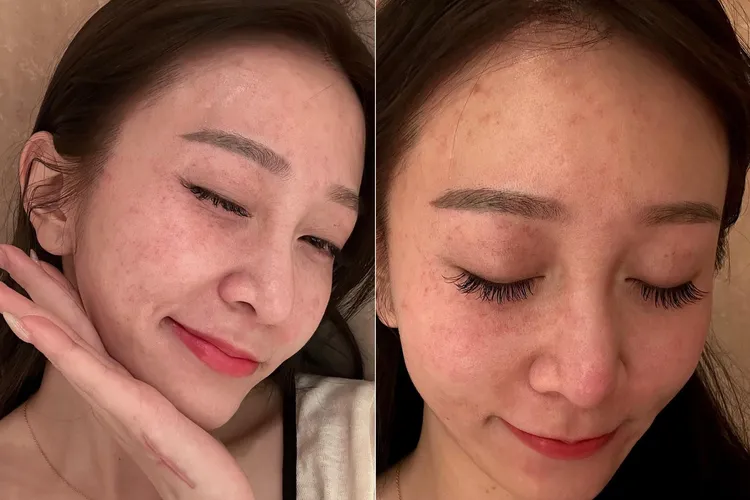 篠崎泫挑戰澳門塔高空彈跳後「全臉微血管爆裂」。取自篠崎泫IG