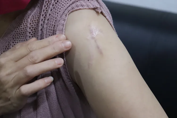 顏小姐的蟹足腫在左肩，還在考慮是否治療。院方提供