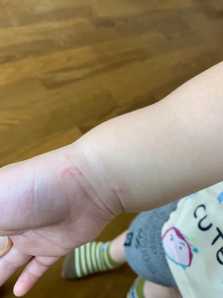 仁武一間幼兒園幼童臉部等部位受傷，老師說是不小心抓傷，教育局調查中。翻攝畫面