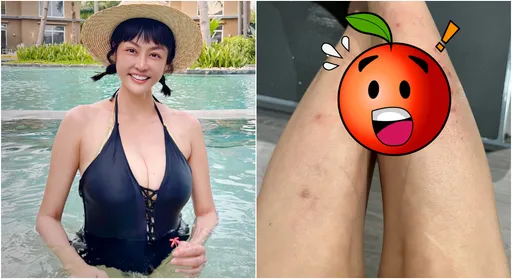罹癌女星身體出狀況!嘆「人生好坎坷」 全身紅疹慘狀曝光