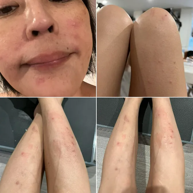 唐玲手腳出現大量紅疹。翻攝自唐玲臉書