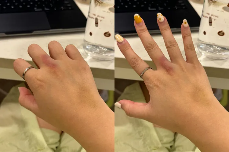 百萬網紅滴妹PO出瘀青照，透露自己上月27日生日在醫院度過。翻攝《crown_du》的IG