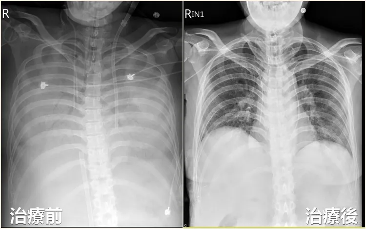 患者因不明原因感染，造成嚴重胸腔及腹腔膿瘍，肺部X光甚至「整片白」。亞大附醫提供