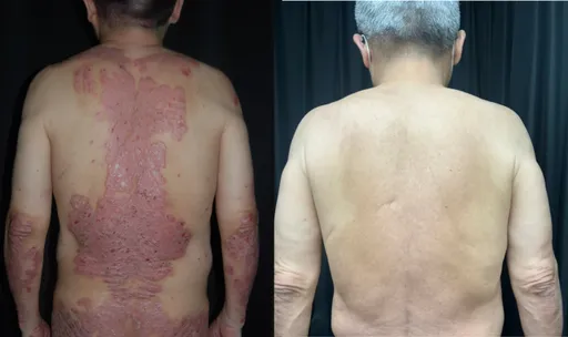 天冷愛吃補小心「抓」狂!乾癬男皮屑掉滿床 醫揭8惡化因子