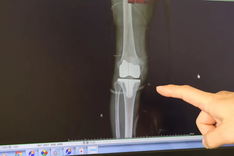 患者膝蓋退化，合併內翻變形15度。院方提供