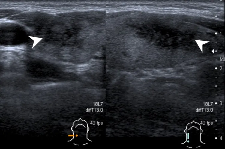 蔡小姐頸部超音波檢查後確診亞急性甲狀腺炎。萬芳醫院提供