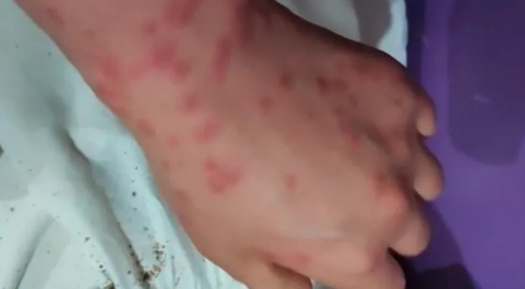 有網友上傳手部遭臭蟲叮咬的模樣。翻攝南韓中央日報