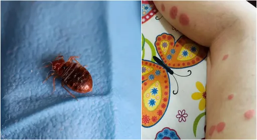 床蝨攻陷南韓!網紅曝切身之痛「咬1包癢10天」:會隨衣物返台