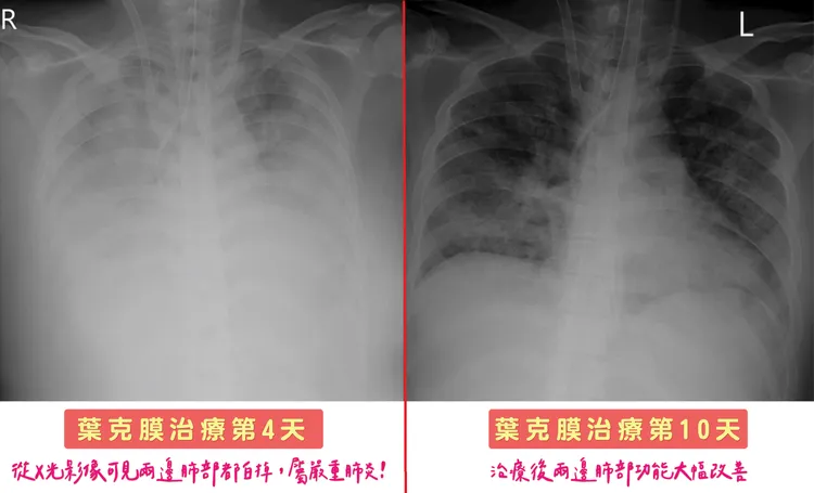 詹小姐經葉克膜治療後，肺部功能明顯恢復。院方提供