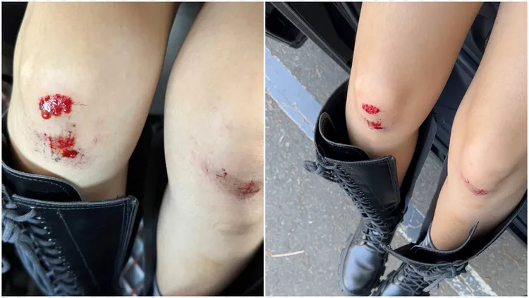 蔡義德的女兒多多跌倒摔傷，膝蓋流血。翻攝蔡義德臉書