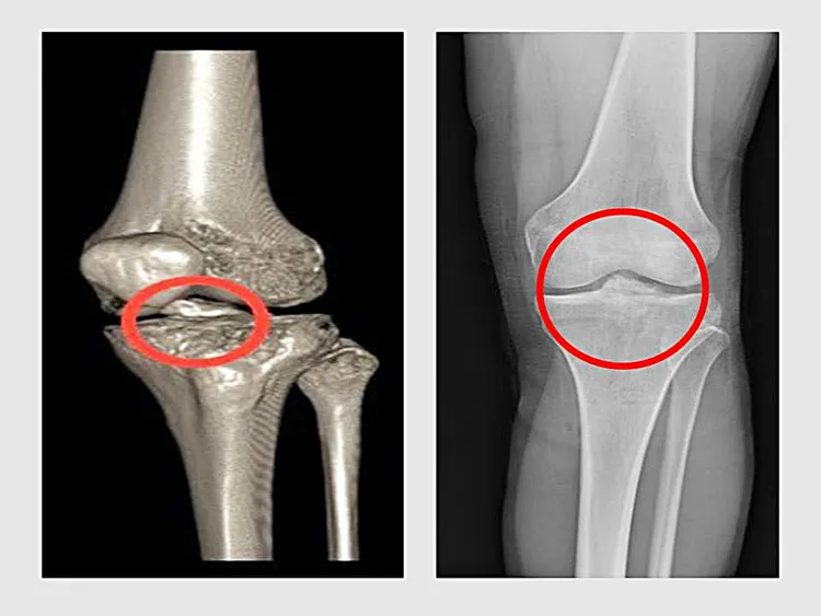 患者左腳膝關節的前十字韌帶在脛骨處產生撕脫性骨折（左圖）；手術後已恢復正常（右圖）。院方提供